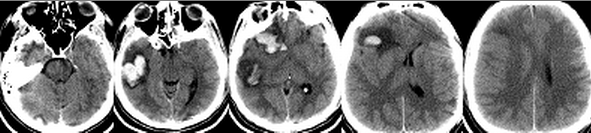 Рисунок 3.КТ исследование головного мозга при поступлении в Институт пациента с травматическими очагами ушиба III-IV вида (наблюдение 3). 