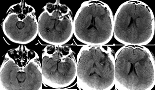 Рисунок 1.КТ исследование головного мозга пациентки с множественным аневризмами сосудов головного мозга (наблюдение 1) в первые сутки после клипирования аневризмы левой ВСА (верхний ряд изображений) и при достижении нормотермии (нижний ряд изображений).