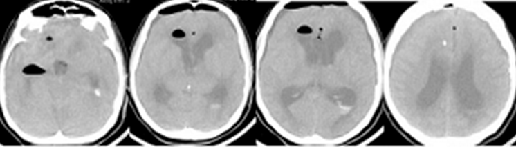 Рисунок 5.КТ исследование головного мозга пациентки с опухолью хиазмально-селлярной области в послеоперационном периоде (наблюдение 10)