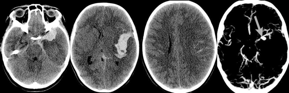 Рис. 1. Пациентка Э., 8 лет. КТ головного мозга (при поступлении). САК, гематома в сильвиевой щели и в проекции полюса левой височной доли. Диффузный отек головного мозга. Латеральная дислокация головного мозга со смещением срединных структур слева направо на 6 мм. Аксиальная дислокация мозга. На СКТ-ангиографии аневризма СМА слева (указано стрелкой).
