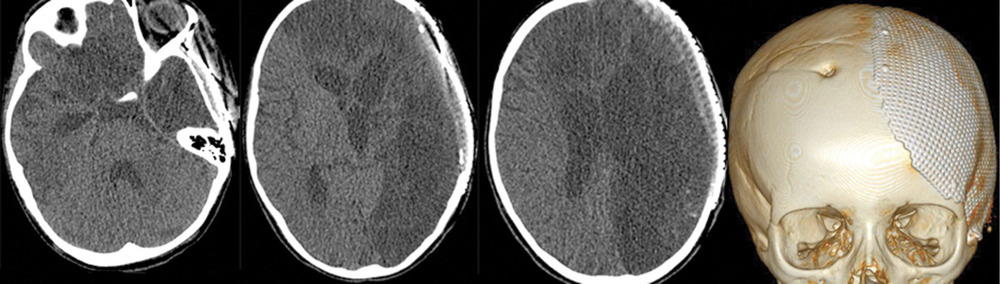 Рис. 6. Пациентка Э., 8 лет. КТ головного мозга (через 2 года после аСАК). Кистозно-глиозные изменения левого полушария и в бассейне передней мозговой аретрии справа.