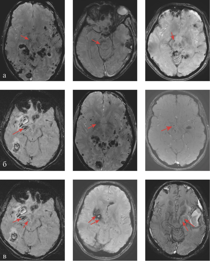 Рис. 2. МРТ головного мозга пациентов с тяжелой ЧМТ с повреждением структур черной субстанции (а), области ядра Мейнерта (б), сочетанным повреждением черной субстанции и области ядра Мейнерта (в). Повреждения указаны стрелками.