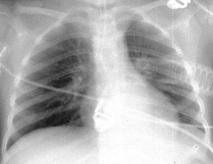 Рисунок 3. Рентгенограмма органов грудной клетки в 4 сутки после операции.