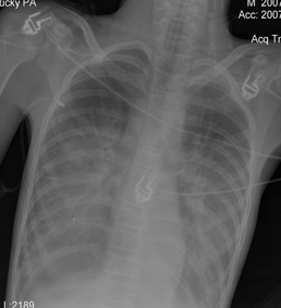 Рисунок 3. Рентгеновский снимок грудной клетки, выполненный спустя 3 часа после поступлении пациента в отделение реанимации.