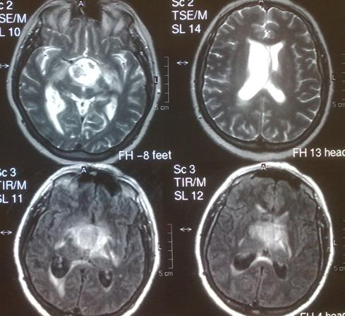 Рисунок 2. МРТ-исследование головного мозга при поступлении пациента в Институт: крупная стебельно-интравентрикулярная кистозная краниофарингиома